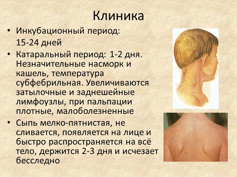 Клиника Инкубационный период:      15-24 дней Катаральный период: 1-2 дня.